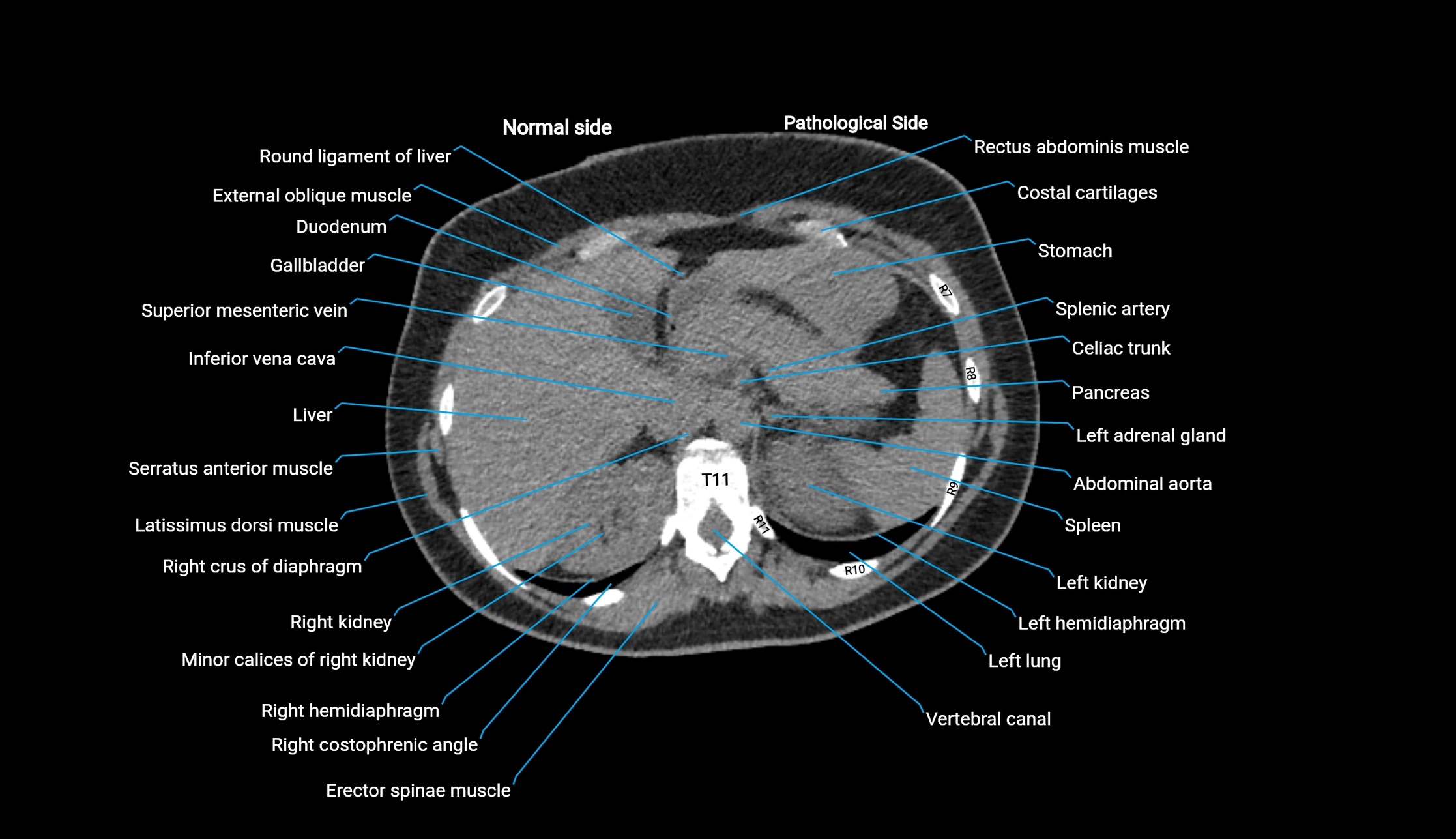 CT KUB axial cross sectional anatomy  radiology image -img-00201-00020.webp